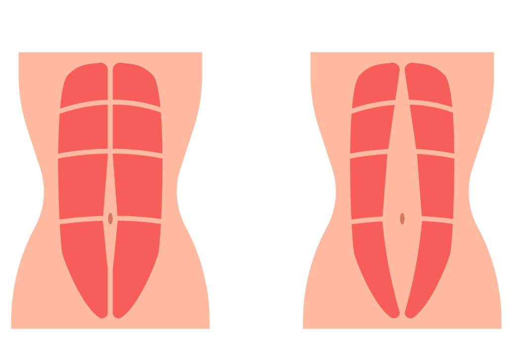 5 Worst Exercises For Diastasis Recti: Avoid These Abdominal Separation Risks