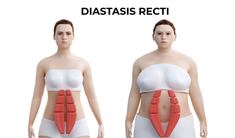 5 Worst Exercises For Diastasis Recti: Avoid These Abdominal Separation Risks