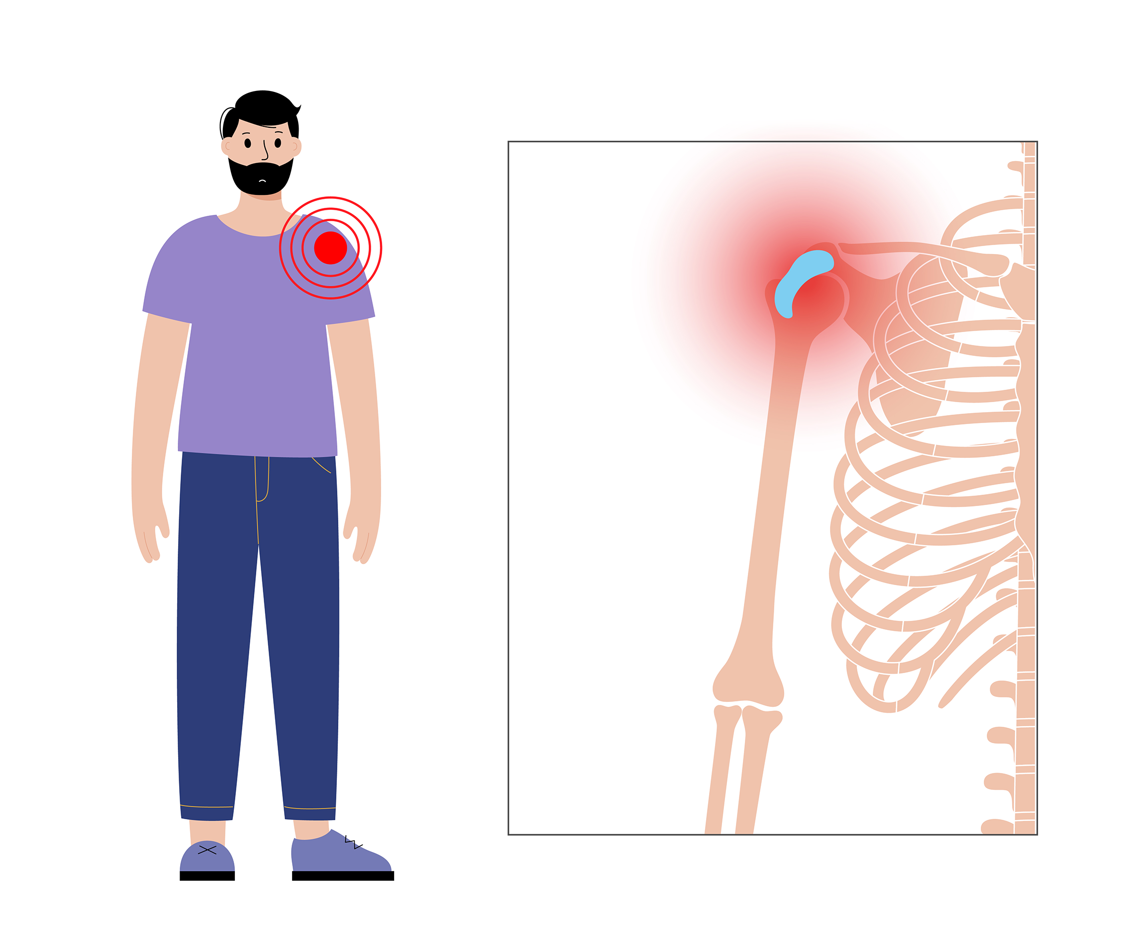 Worst Exercises For Shoulder Impingement - Top Exercises To Avoid