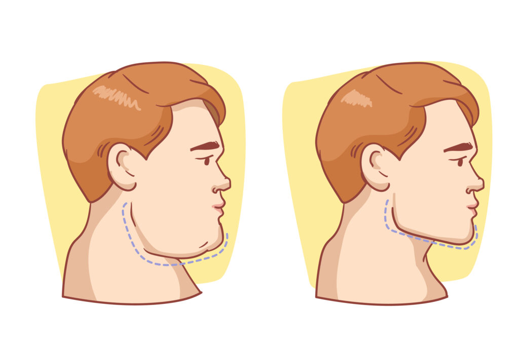 Can Neck Exercises Reduce Double Chin? Get Rid Of Fat And Sculpt Your Jawline!