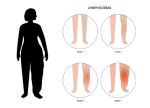 Why Is Exercise Good For The Lymphatic System? Find Out Now! Key To Improving Lymphoedema